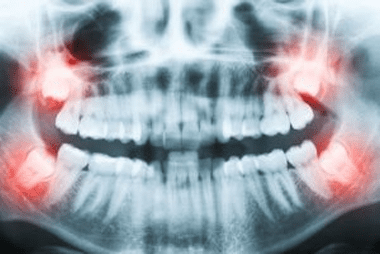 Dental X-ray showing wisdom teeth with inflammation on both sides.